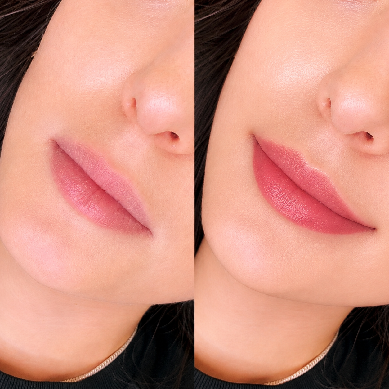 Before and after of a subtle lip flip enhancement